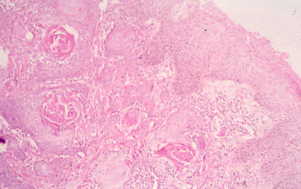 06sqcarcinomascrotum2.jpg 67.6K