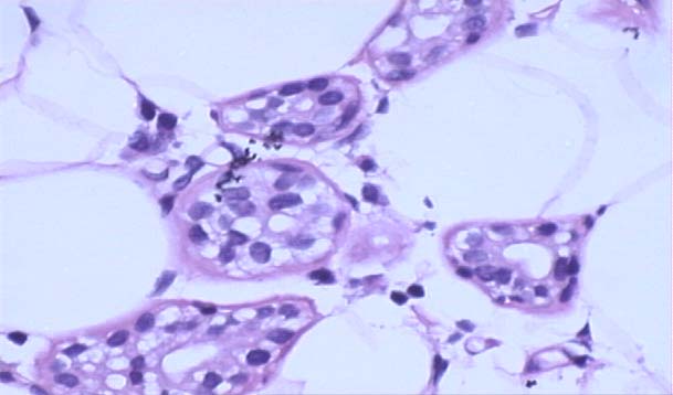 Microglandular Adenosis