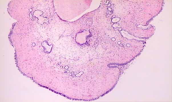 allergic nasal polyp