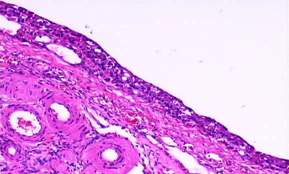 Cystic Follicles