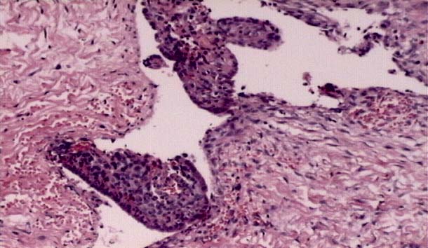 Endometriotic Cyst
