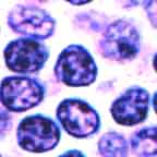 Small lymphocytic lymphoma