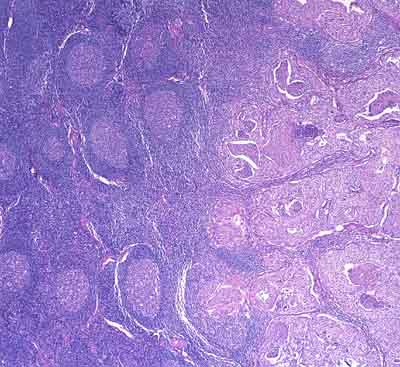 Squamous carcinoma