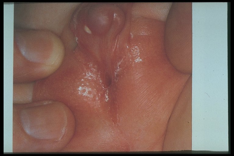 This infant has small penis with normal urethra small narrow vagina leading