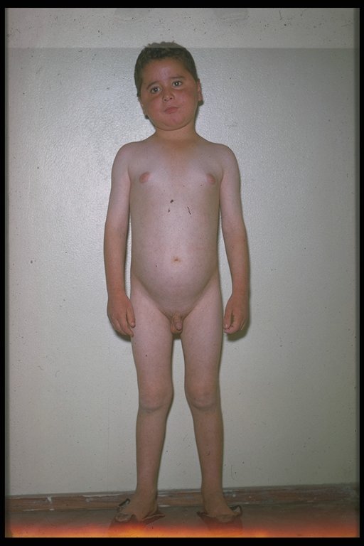 Precoccious puberty in a boy due to cancer of the adrenal gland