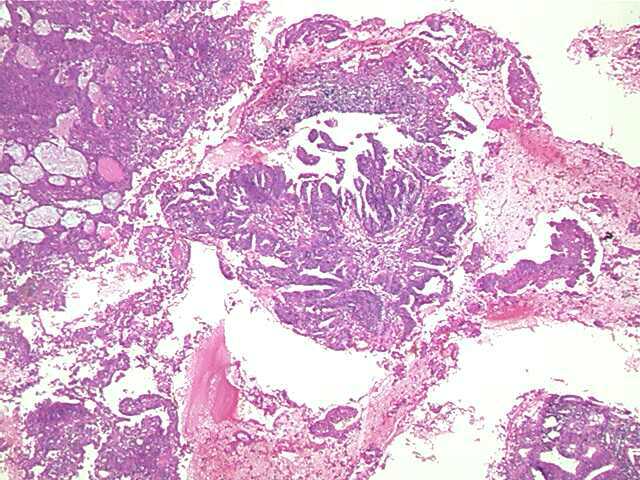 endometrialcarcinoma01.jpg 64.3K