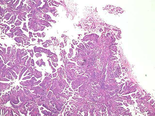 endometrialcarcinoma02.jpg 59.7K