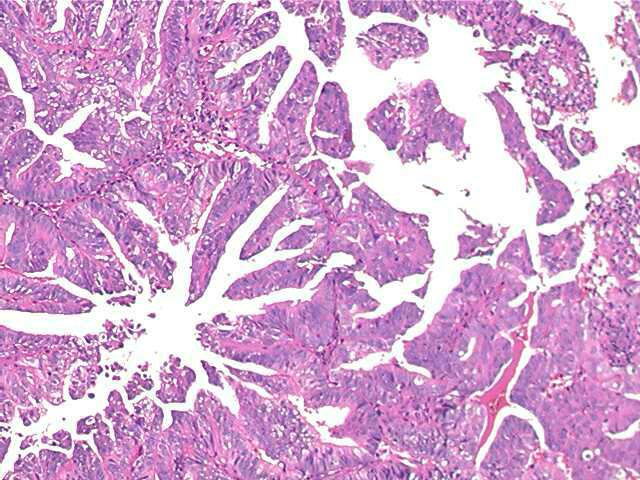 endometrialcarcinoma03.jpg 61.9K