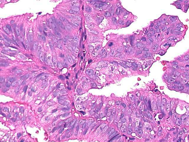 endometrialcarcinoma05.jpg 55.2K