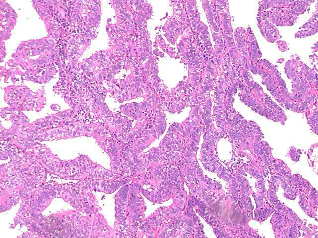 endometrialcarcinoma06.jpg 63.6K