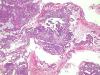 endometrialcarcinoma07.jpg 3.3K