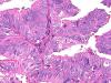 endometrialcarcinoma11.jpg 3.4K