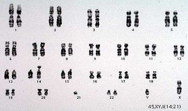 Karyotype Of Down Syndrome. Karyotype 45