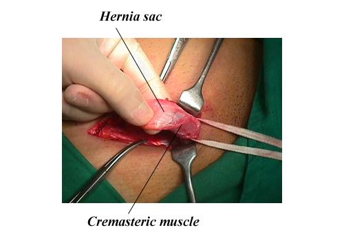 herniar14.jpg (95157 bytes)