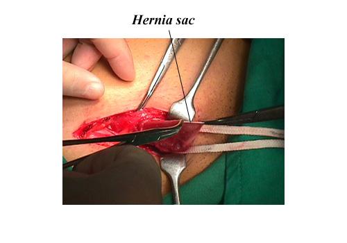 herniar16.JPG (48879 bytes)