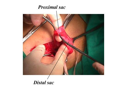 herniar21.JPG (50738 bytes)
