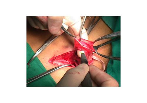 herniar22.JPG (50053 bytes)