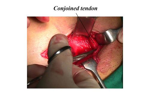 herniar35.JPG (48313 bytes)