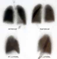 normal perfusion