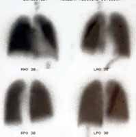 normal perfusion